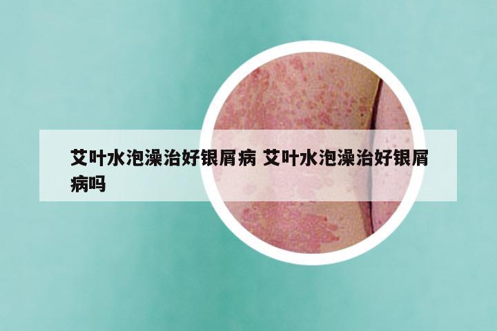 艾叶水泡澡治好银屑病 艾叶水泡澡治好银屑病吗