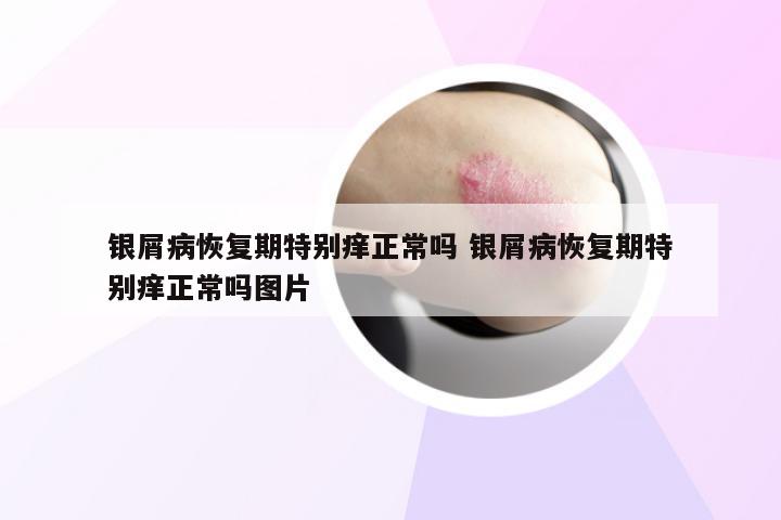 银屑病恢复期特别痒正常吗 银屑病恢复期特别痒正常吗图片