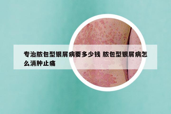 专治脓包型银屑病要多少钱 脓包型银屑病怎么消肿止痛