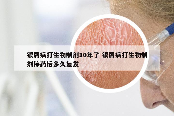 银屑病打生物制剂10年了 银屑病打生物制剂停药后多久复发