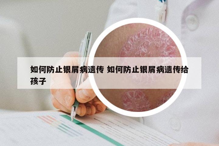 如何防止银屑病遗传 如何防止银屑病遗传给孩子