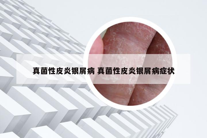 真菌性皮炎银屑病 真菌性皮炎银屑病症状
