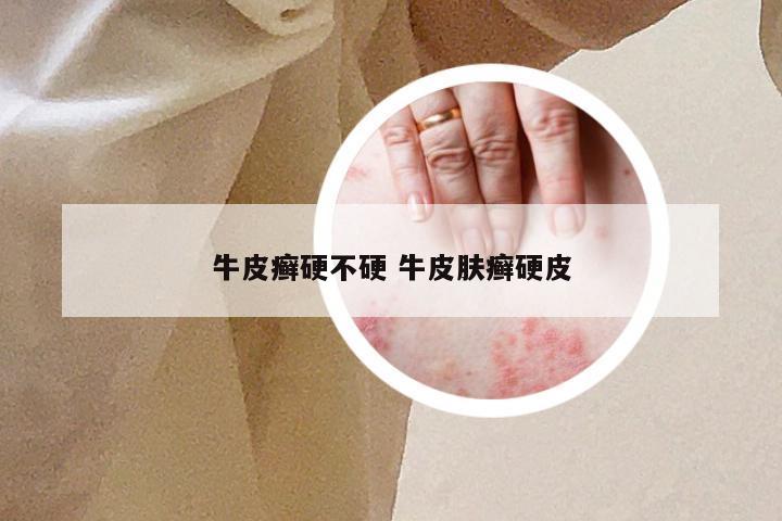 牛皮癣硬不硬 牛皮肤癣硬皮