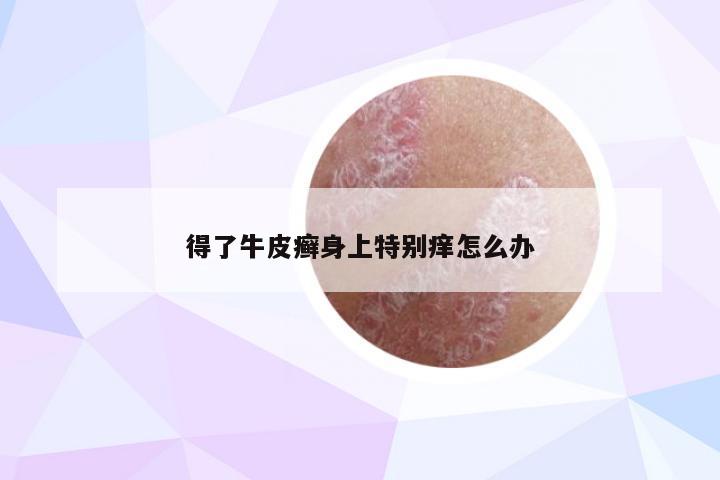 得了牛皮癣身上特别痒怎么办