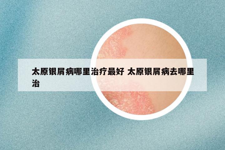 太原银屑病哪里治疗最好 太原银屑病去哪里治