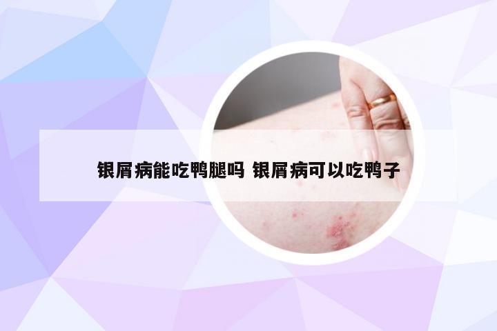 银屑病能吃鸭腿吗 银屑病可以吃鸭子