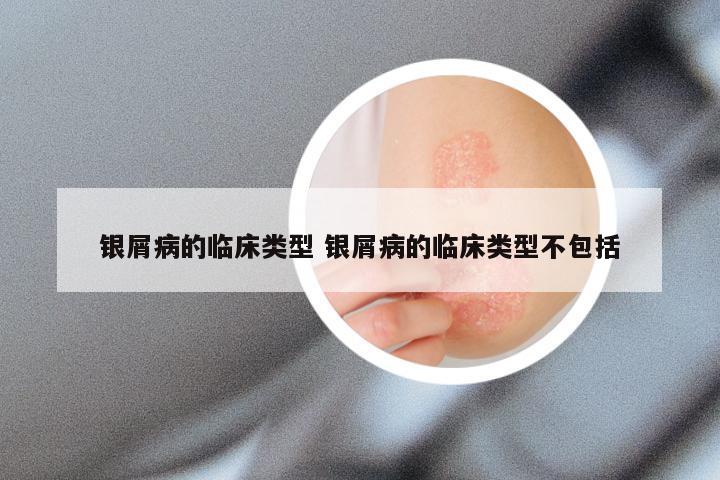 银屑病的临床类型 银屑病的临床类型不包括