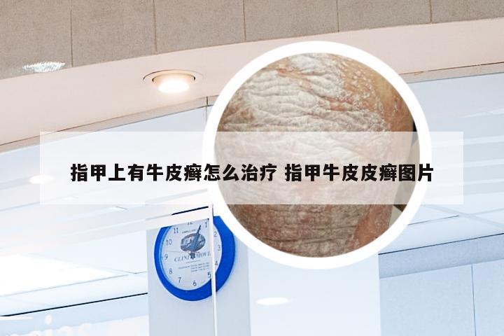 指甲上有牛皮癣怎么治疗 指甲牛皮皮癣图片
