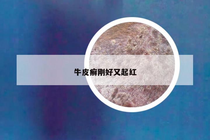 牛皮癣刚好又起红