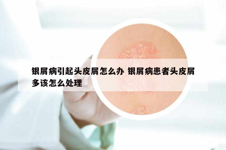 银屑病引起头皮屑怎么办 银屑病患者头皮屑多该怎么处理