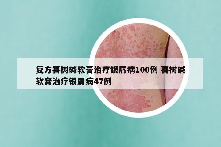复方喜树碱软膏治疗银屑病100例 喜树碱软膏治疗银屑病47例