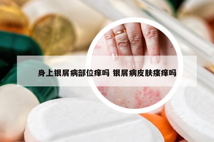 身上银屑病部位痒吗 银屑病皮肤瘙痒吗