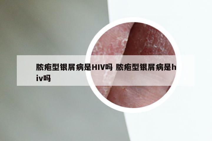 脓疱型银屑病是HIV吗 脓疱型银屑病是hiv吗