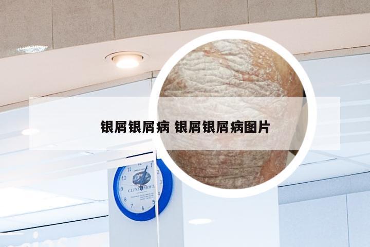 银屑银屑病 银屑银屑病图片