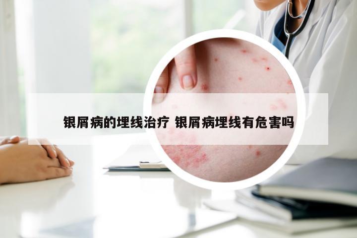 银屑病的埋线治疗 银屑病埋线有危害吗