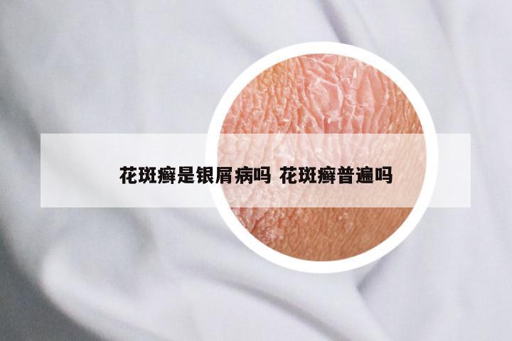 花斑癣是银屑病吗 花斑癣普遍吗