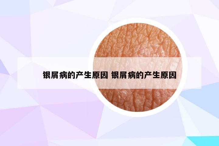 银屑病的产生原因 银屑病的产生原因
