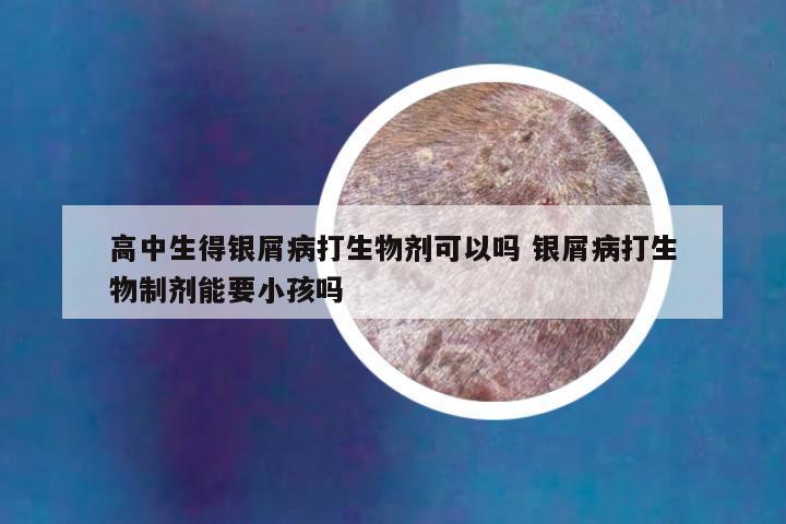 高中生得银屑病打生物剂可以吗 银屑病打生物制剂能要小孩吗