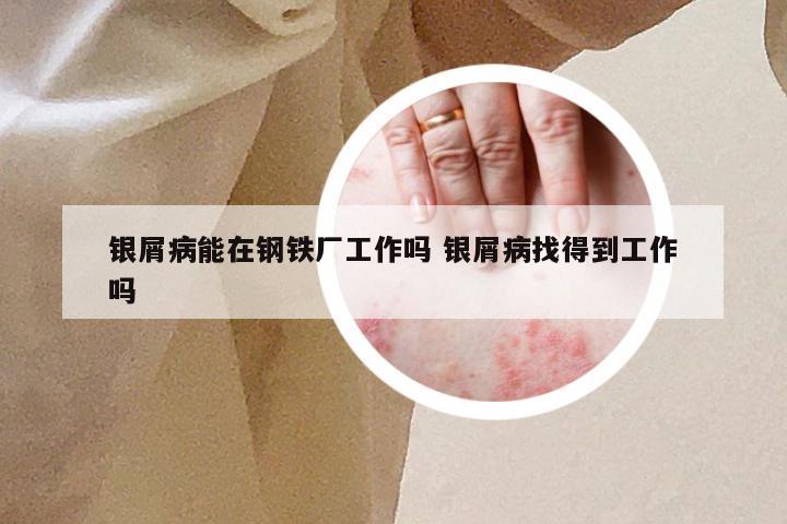 银屑病能在钢铁厂工作吗 银屑病找得到工作吗
