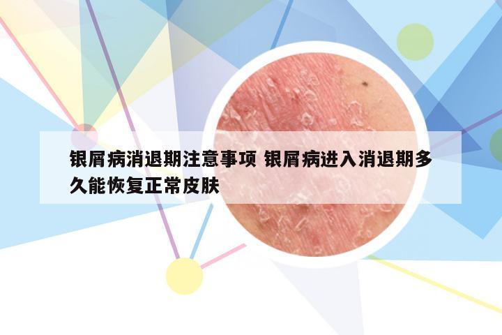 银屑病消退期注意事项 银屑病进入消退期多久能恢复正常皮肤