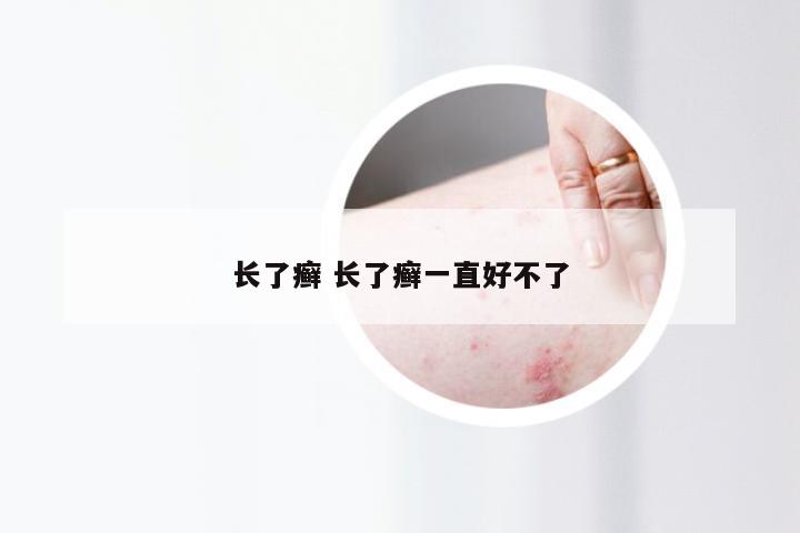 长了癣 长了癣一直好不了