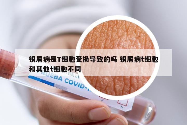 银屑病是T细胞受损导致的吗 银屑病t细胞和其他t细胞不同