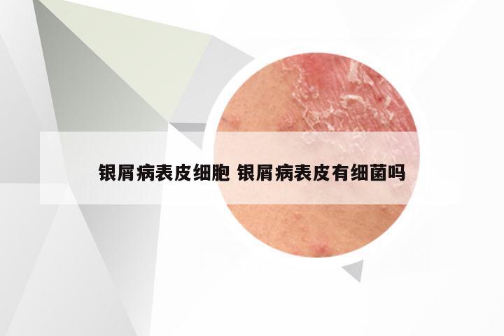 银屑病表皮细胞 银屑病表皮有细菌吗