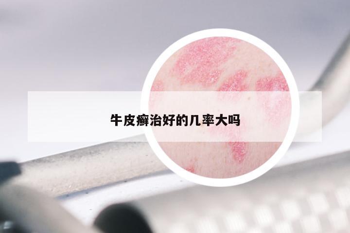 牛皮癣治好的几率大吗