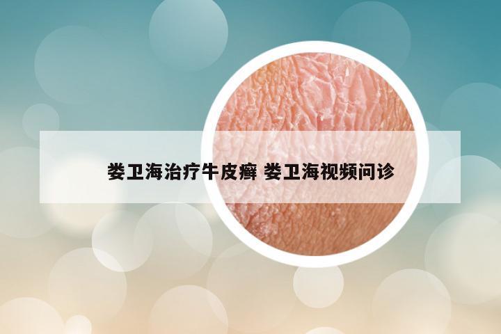 娄卫海治疗牛皮癣 娄卫海视频问诊