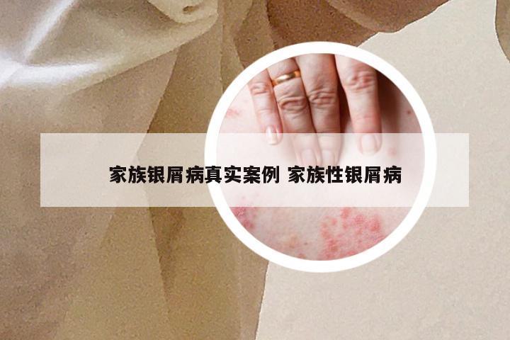 家族银屑病真实案例 家族性银屑病