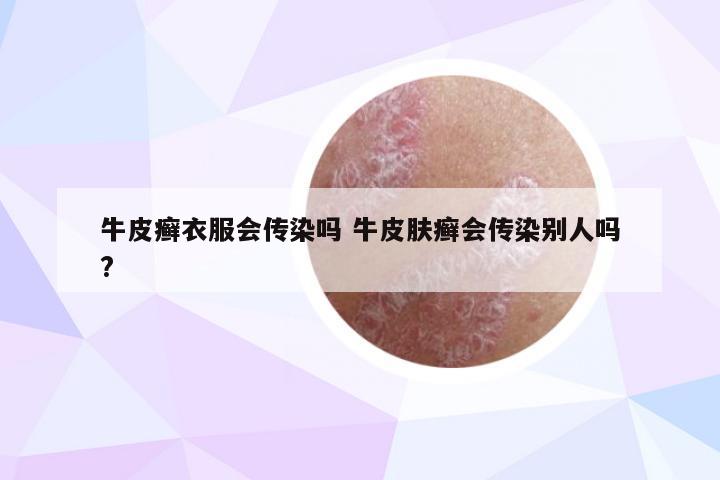 牛皮癣衣服会传染吗 牛皮肤癣会传染别人吗?