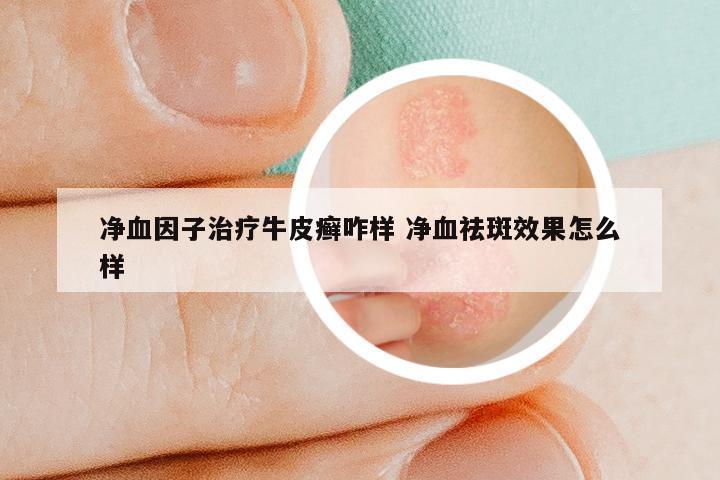 净血因子治疗牛皮癣咋样 净血祛斑效果怎么样