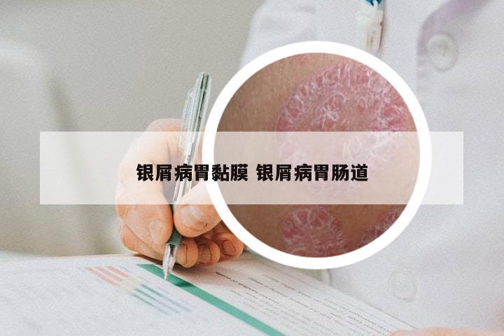 银屑病胃黏膜 银屑病胃肠道