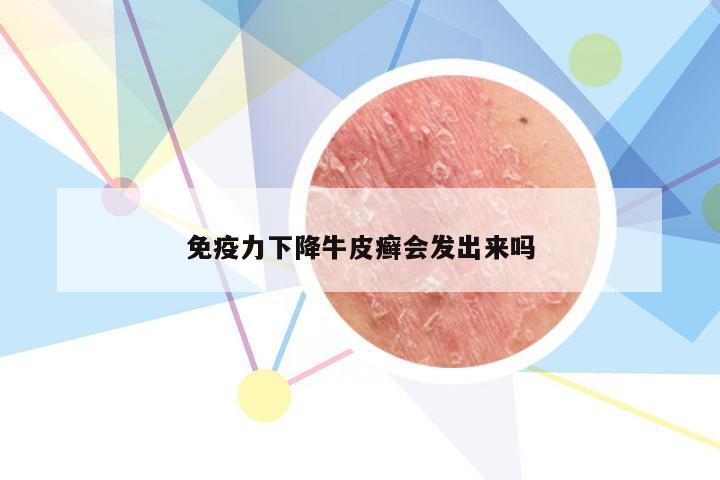 免疫力下降牛皮癣会发出来吗