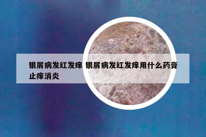 银屑病发红发痒 银屑病发红发痒用什么药膏止痒消炎