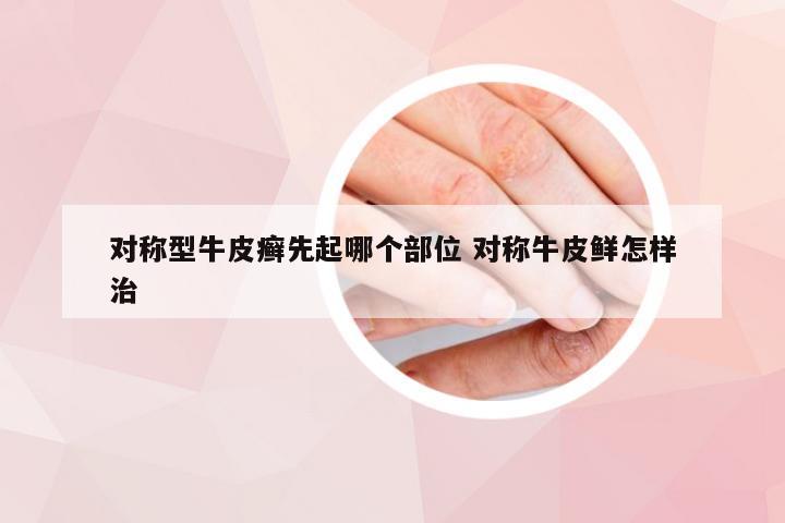 对称型牛皮癣先起哪个部位 对称牛皮鲜怎样治