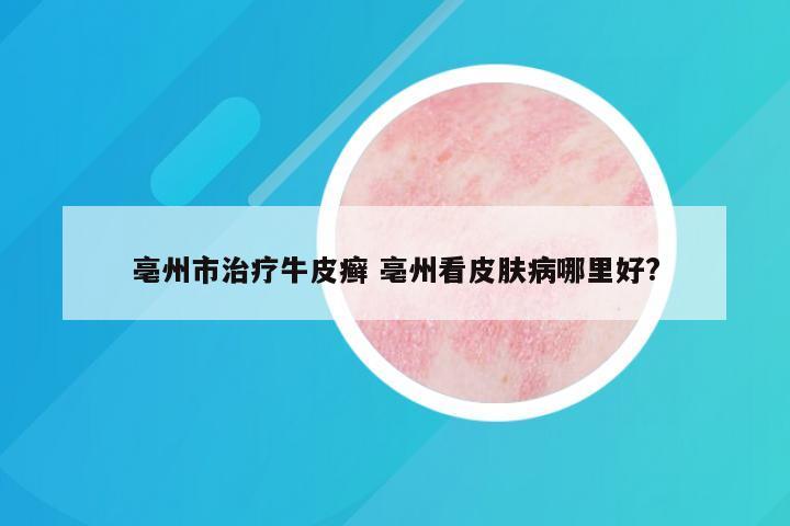 亳州市治疗牛皮癣 亳州看皮肤病哪里好?