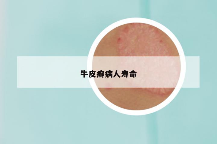 牛皮癣病人寿命