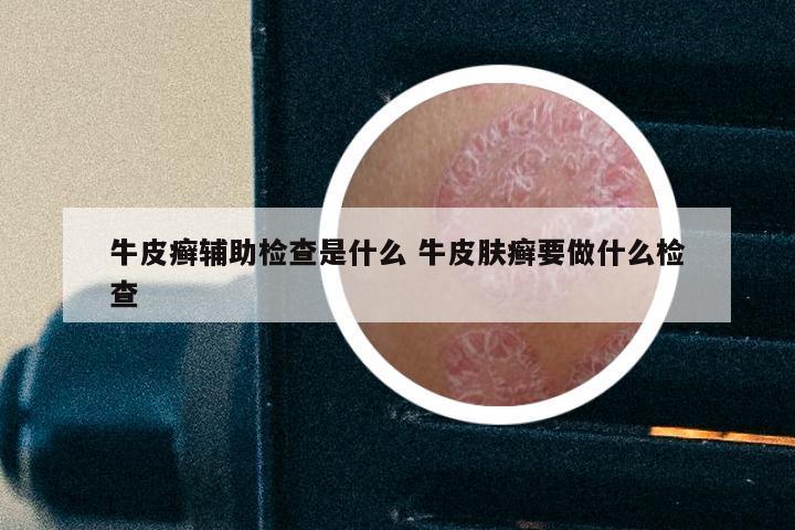 牛皮癣辅助检查是什么 牛皮肤癣要做什么检查