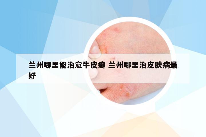 兰州哪里能治愈牛皮癣 兰州哪里治皮肤病最好