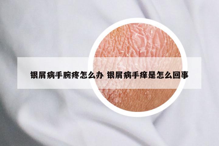 银屑病手腕疼怎么办 银屑病手痒是怎么回事