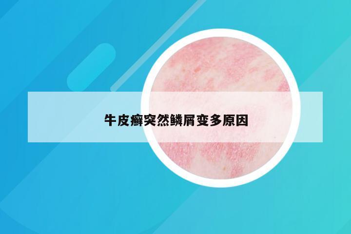 牛皮癣突然鳞屑变多原因