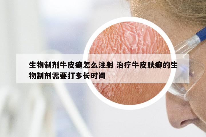 生物制剂牛皮癣怎么注射 治疗牛皮肤癣的生物制剂需要打多长时间