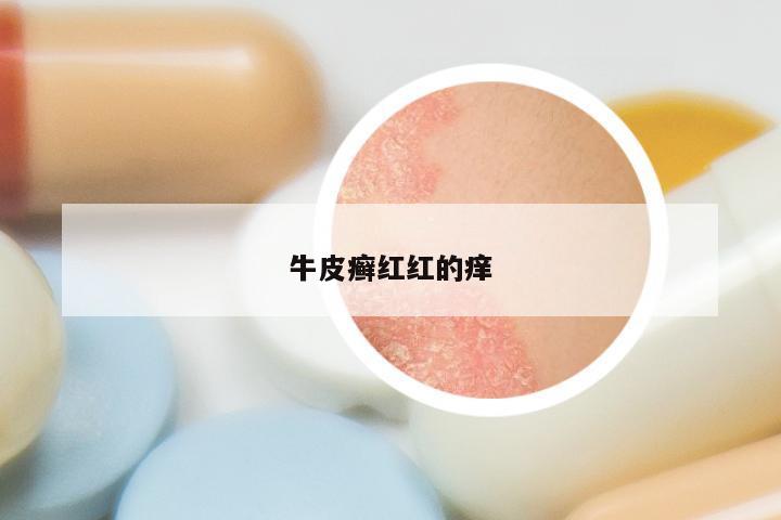 牛皮癣红红的痒