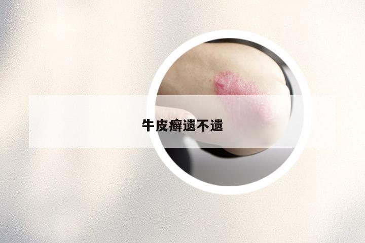 牛皮癣遗不遗