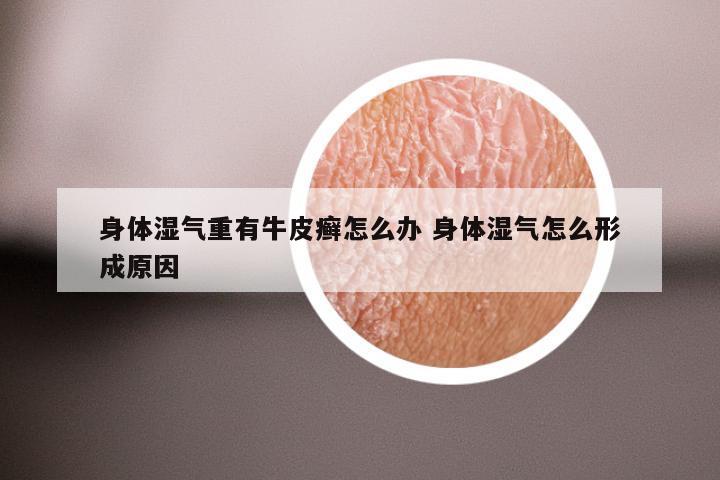 身体湿气重有牛皮癣怎么办 身体湿气怎么形成原因
