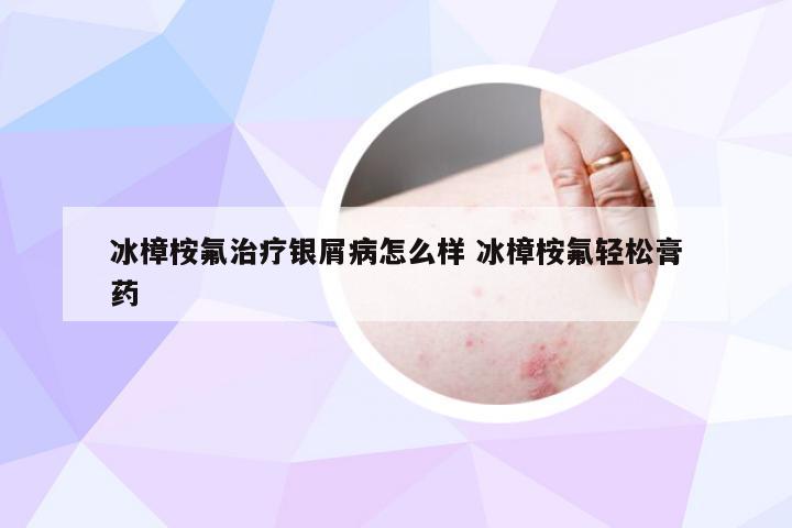 冰樟桉氟治疗银屑病怎么样 冰樟桉氟轻松膏药