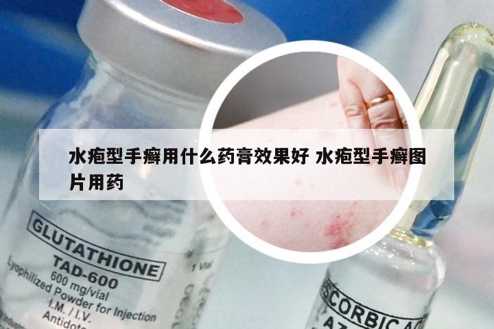 水疱型手癣用什么药膏效果好 水疱型手癣图片用药