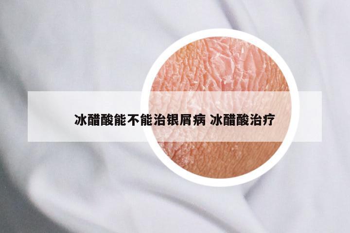 冰醋酸能不能治银屑病 冰醋酸治疗