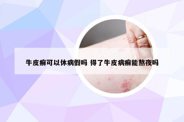 牛皮癣可以休病假吗 得了牛皮病癣能熬夜吗
